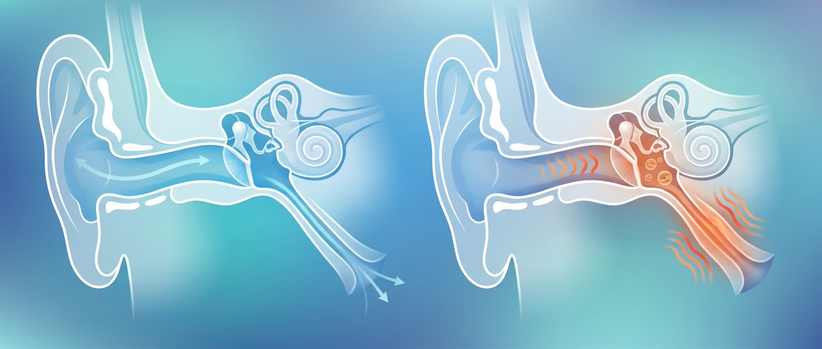 Medical illustration showing eustachian tube dysfunction anatomy