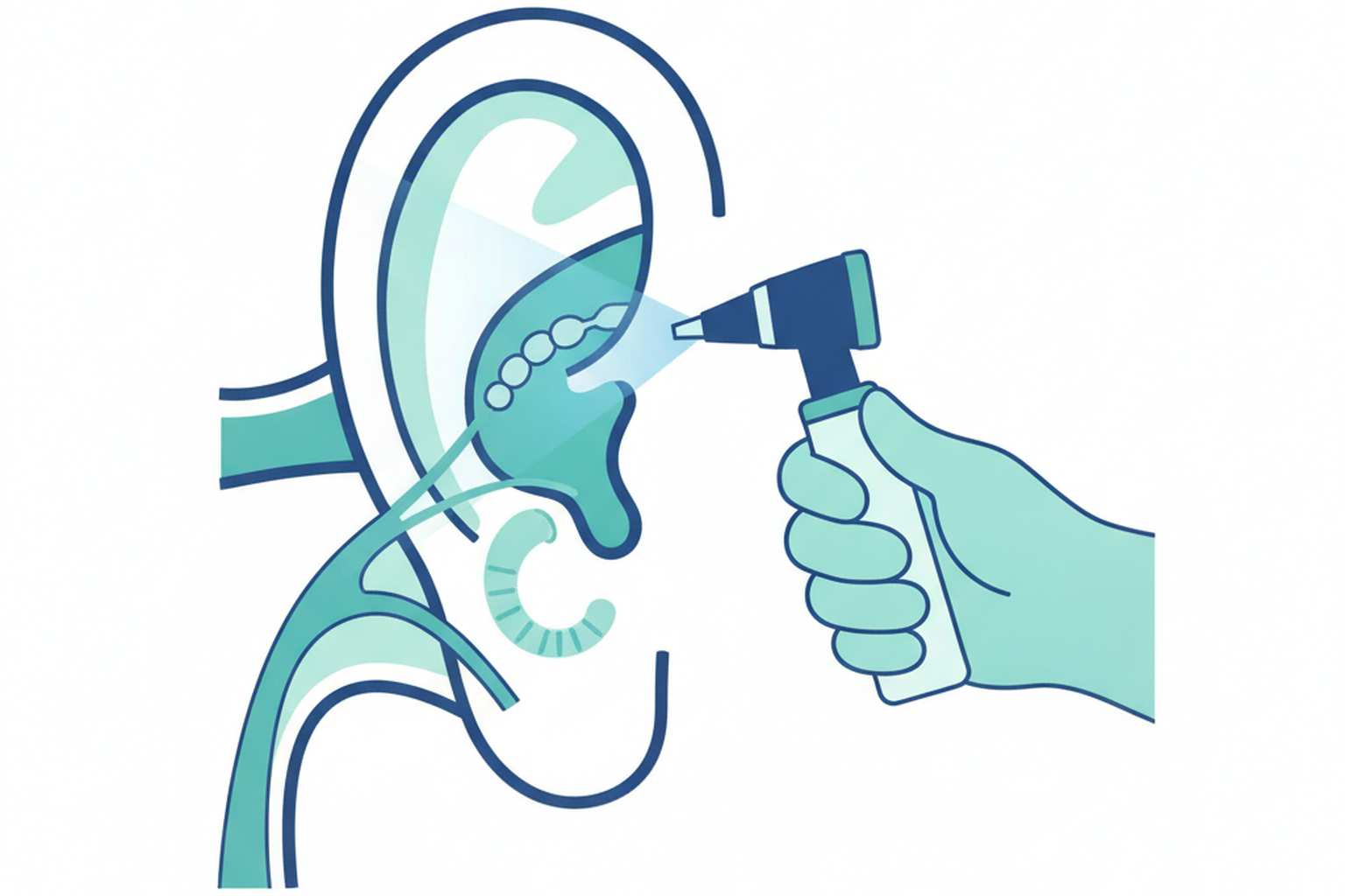 Medical illustration of earwax building up and blocking the ear canal