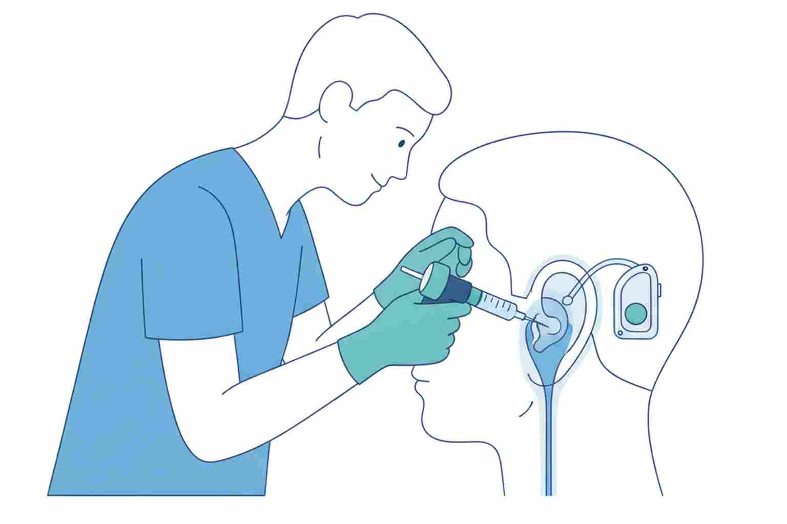 Medical illustration of ear canal impression for custom hearing aid fitting