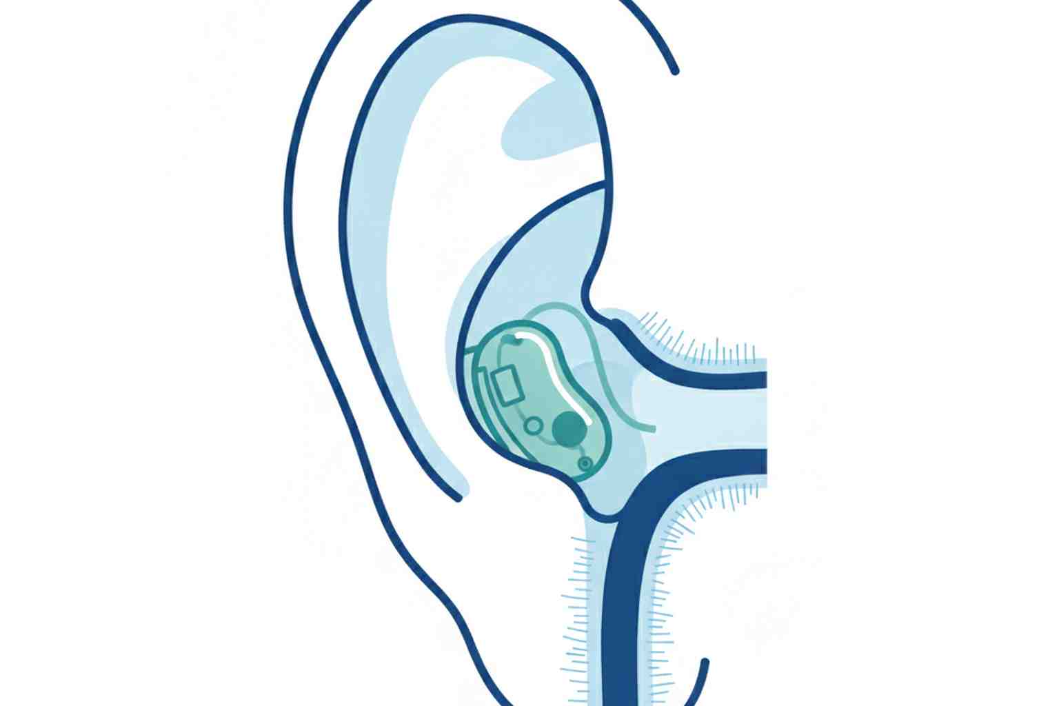 Medical illustration of invisible hearing aid inside ear canal