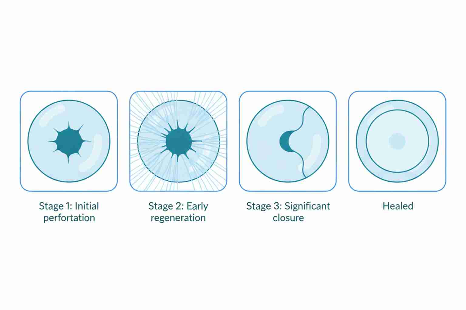 Healing stages of a perforated eardrum