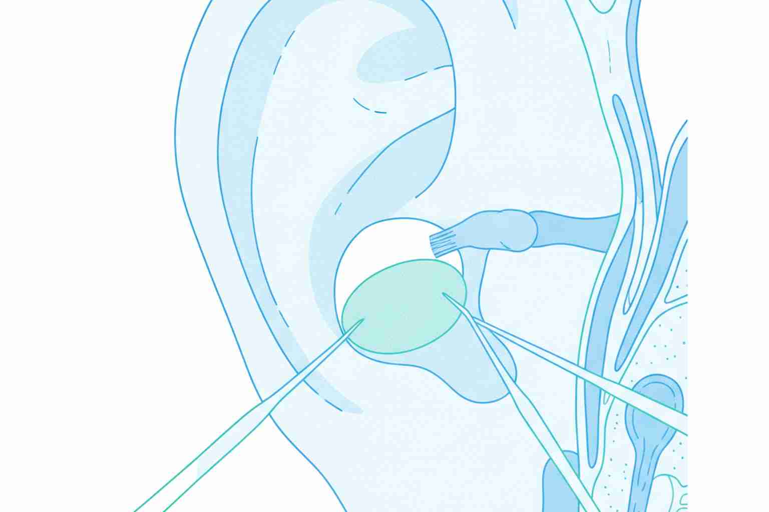 Surgical repair of a perforated eardrum